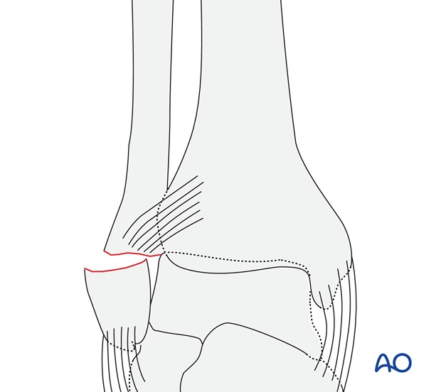 Transverse fracture of the lateral malleolus (AO/OTA 44A1.3)