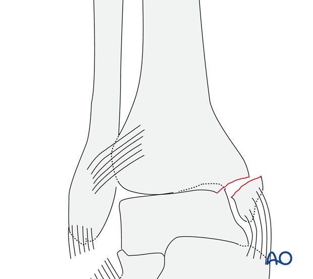 Rupture of the lateral collateral ligaments (AO/OTA 44A2.1)