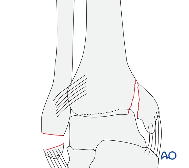 Avulsion of the tip of the lateral malleolus (AO/OTA 44A2.2)