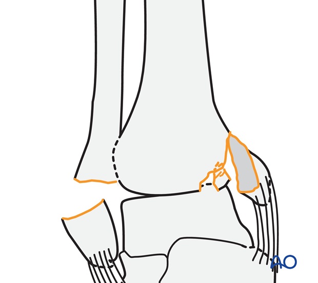 Transverse fracture of the lateral malleolus (AO/OTA 44A2.3)