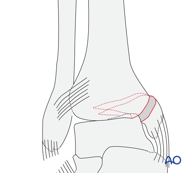 Rupture of the lateral collateral ligaments (AO/OTA 44A3.1)