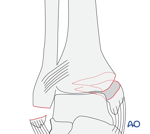 Avulsion of the tip of the lateral malleolus (AO/OTA 44A3.2)