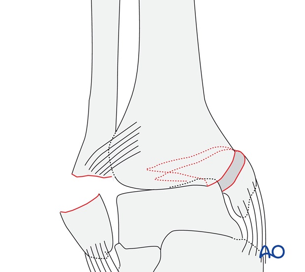 Transverse fracture of the lateral malleolus (AO/OTA 44A3.3)