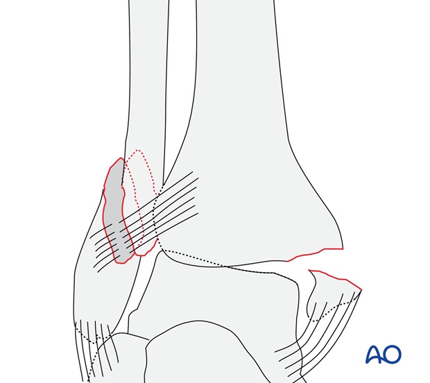 Simple, with fracture of the medial malleolus (AO/OTA 44B2.2)