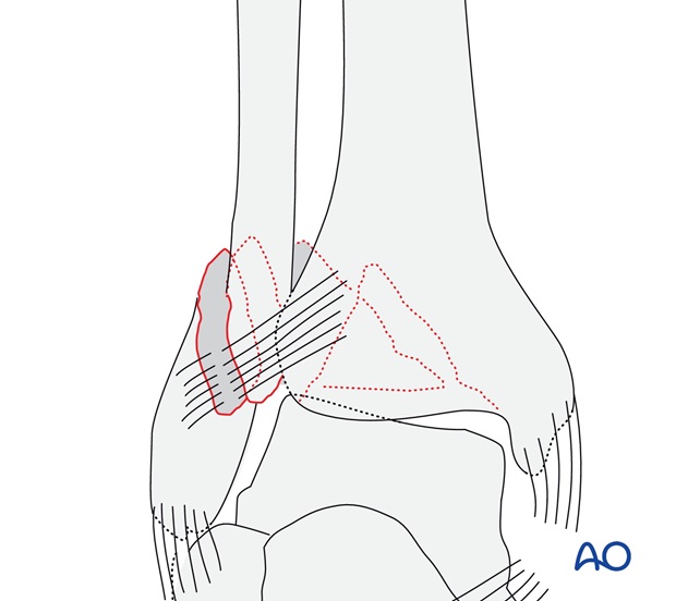 Simple, with ruptured medial collateral ligament (AO/OTA 44B3.1)