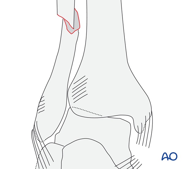 Simple, with ruptured medial collateral ligament (AO/OTA 44C1.1)