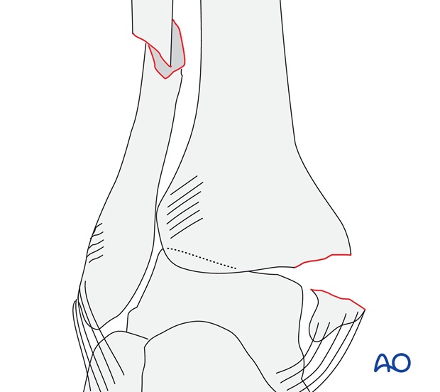 Simple, with fracture of the medial malleolus (AO/OTA 44C1.2)