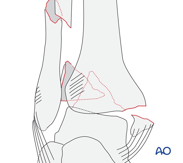 With fractured medial malleolus and a Volkmann's (AO/OTA 44C1.3)