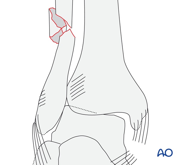 With rupture of the medial collateral ligament (AO/OTA 44C2.1)