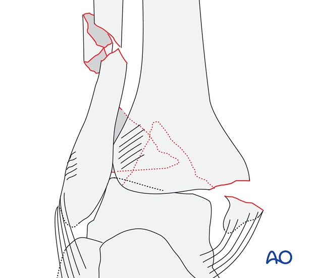 With fracture (medial malleolus) and a Volkmann's (AO/OTA 44C2.3)