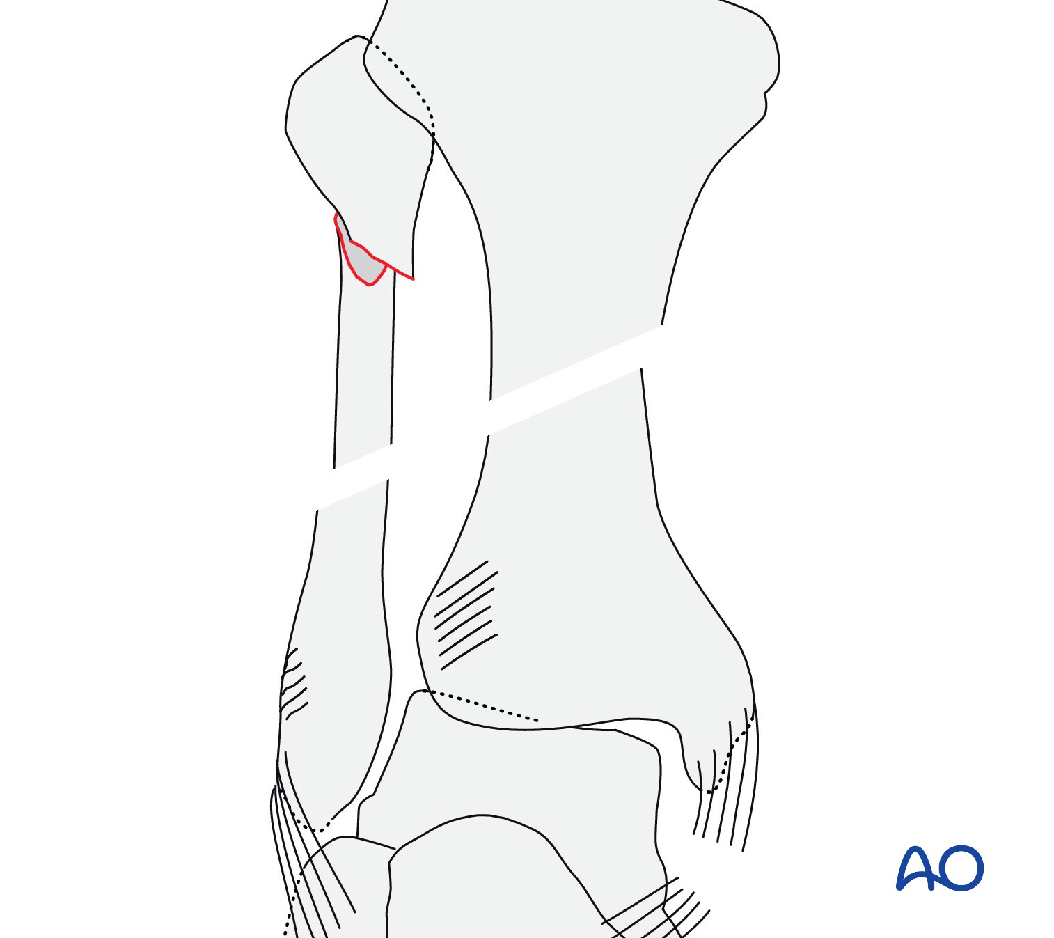 Audible disease FRACTURE FR-1 トレモロ Audible disease FRACTURE FR