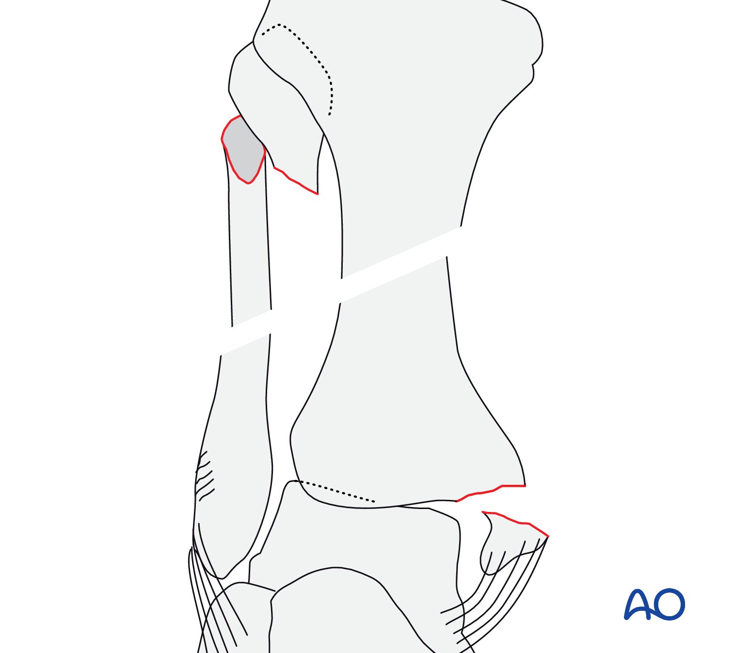 Frontiers | Tibial plateau fracture and RNA sequencing with