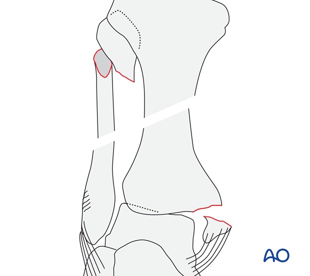 With shortening, without Volkmann's (AO/OTA 44C3.2)