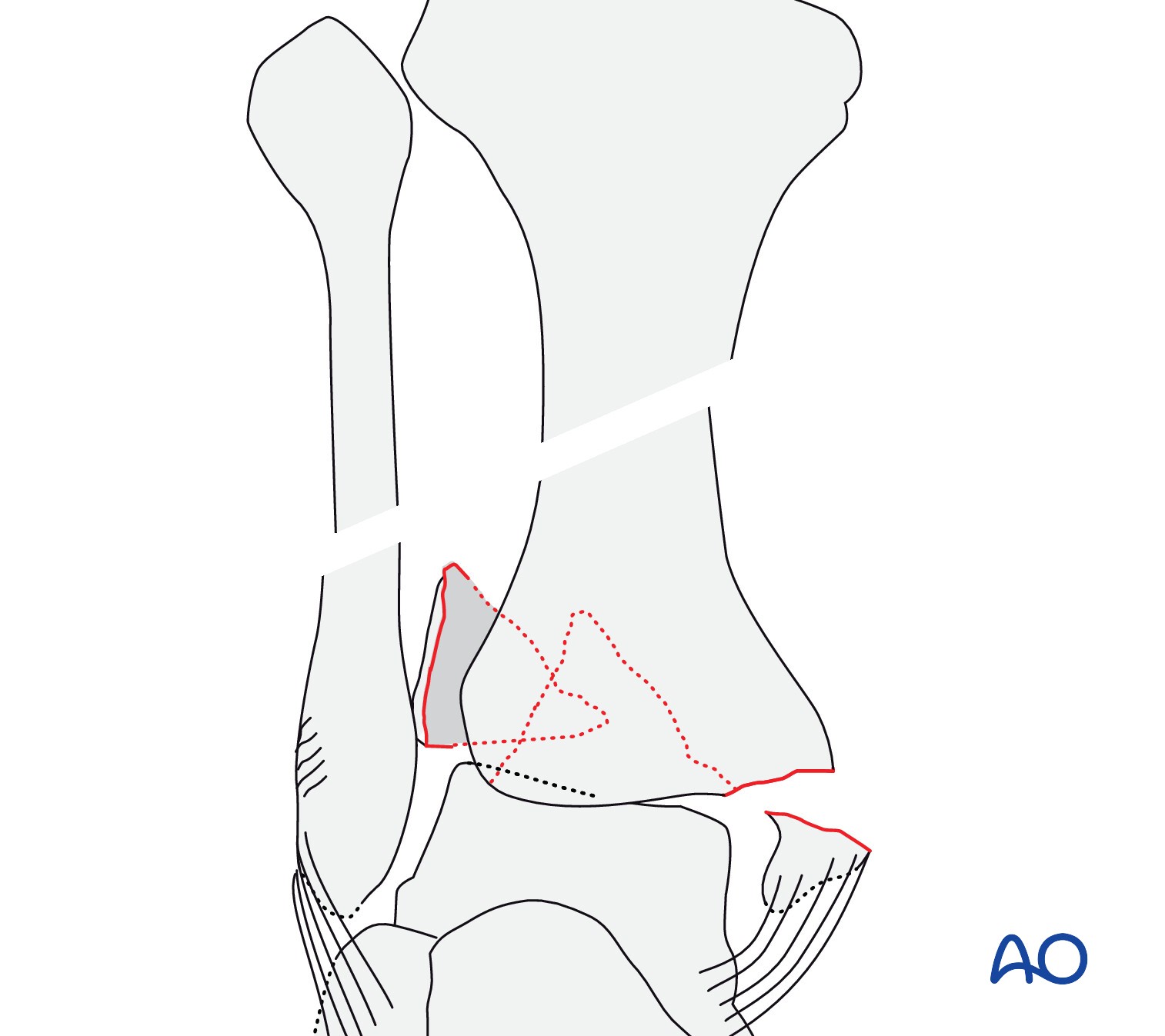 Audible disease FRACTURE FR-1 トレモロ Freiberg's Disease - Foot & Ankle - Orthobullets