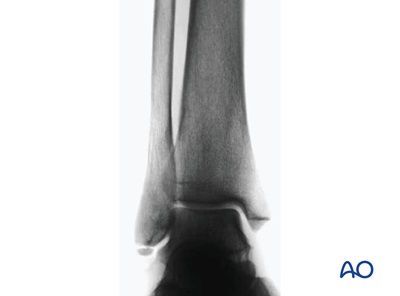 Infrasyndesmotic, lateral isolated ligament rupture/avulsion fracture