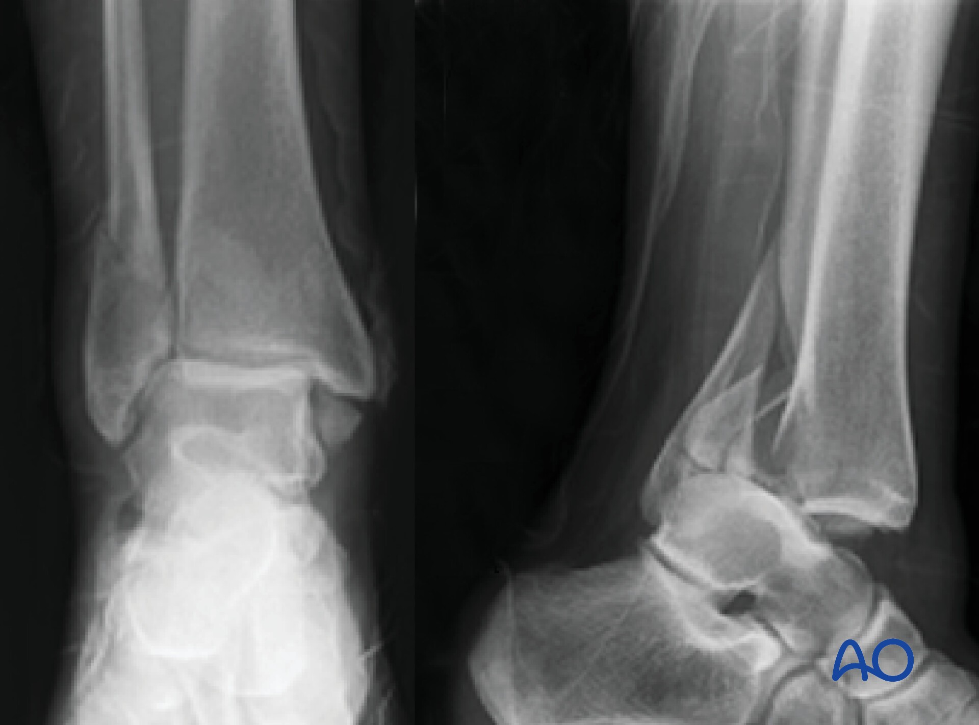 Audible disease FRACTURE FR-1 トレモロ Audible disease FRACTURE FR-1 トレモロ