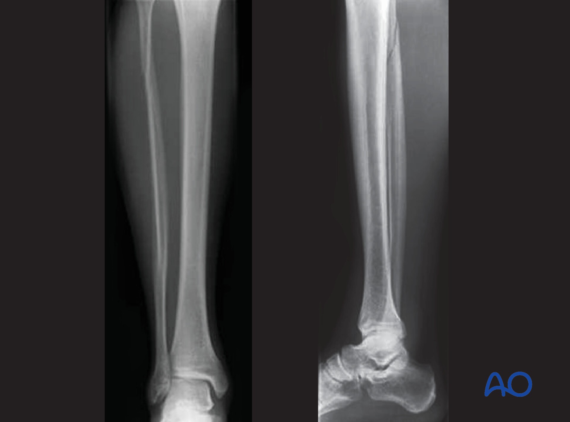Audible disease FRACTURE FR-1 トレモロ Audible Disease :: Fracture FR-1