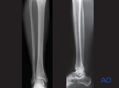 Suprasyndesmotic, Proximal Fibular Fracture, Medial Injury 