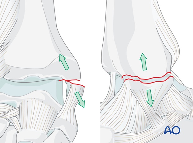 medial transverse fracture tension band wiring