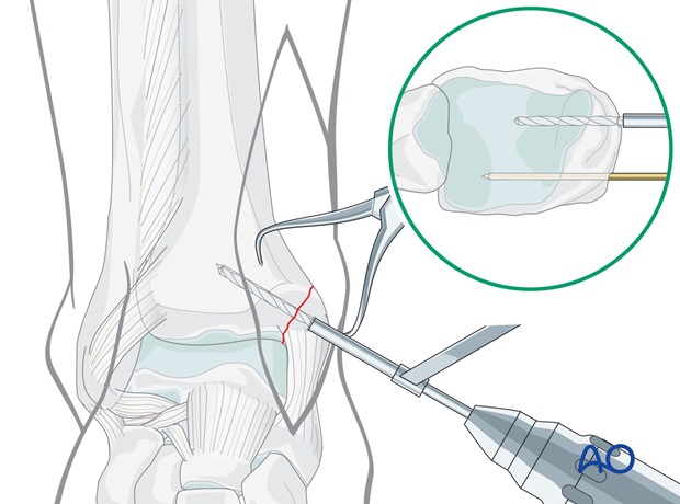 lag screws oblique or vertical fractures