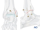 posteromedial extension fracture lag screw