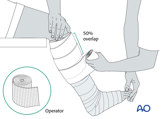 Circular cast for Infrasyndesmotic, posteromedial fracture with LCL rupture