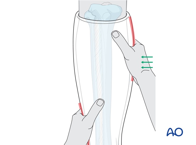 Circular cast for Infrasyndesmotic, lateral isolated ligament rupture ...