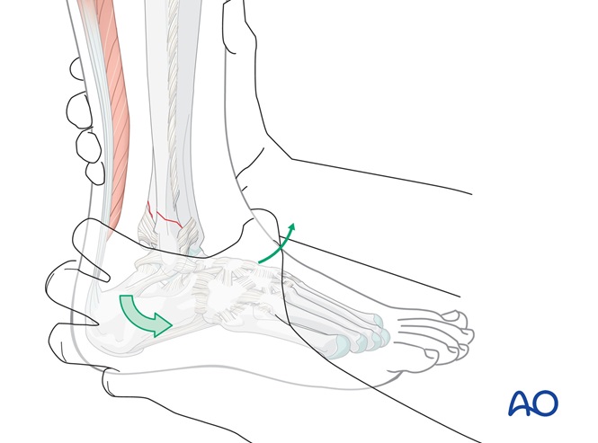 Circular cast for Transsyndesmotic, posterior, lateral simple, and ...