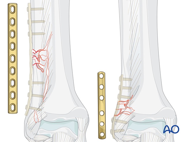 Fibula, multifragmentary fracture: lateral bridging plate