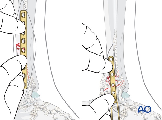 fibula multifragmentary fracture lateral bridging plate