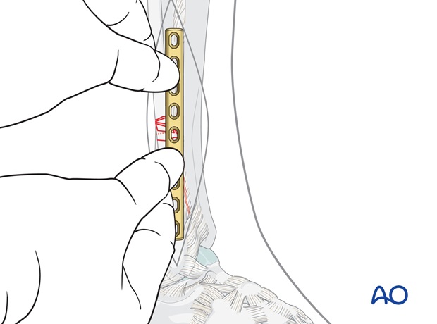 fibula multifragmentary c fracture lateral bridging plate