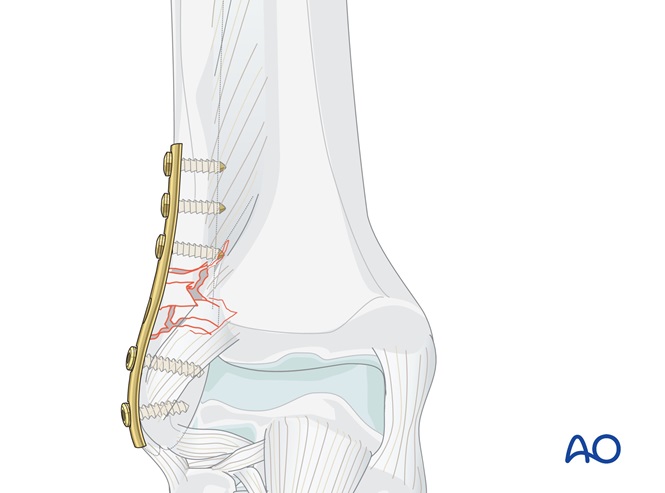 Fibula, multifragmentary fracture: lateral bridging plate