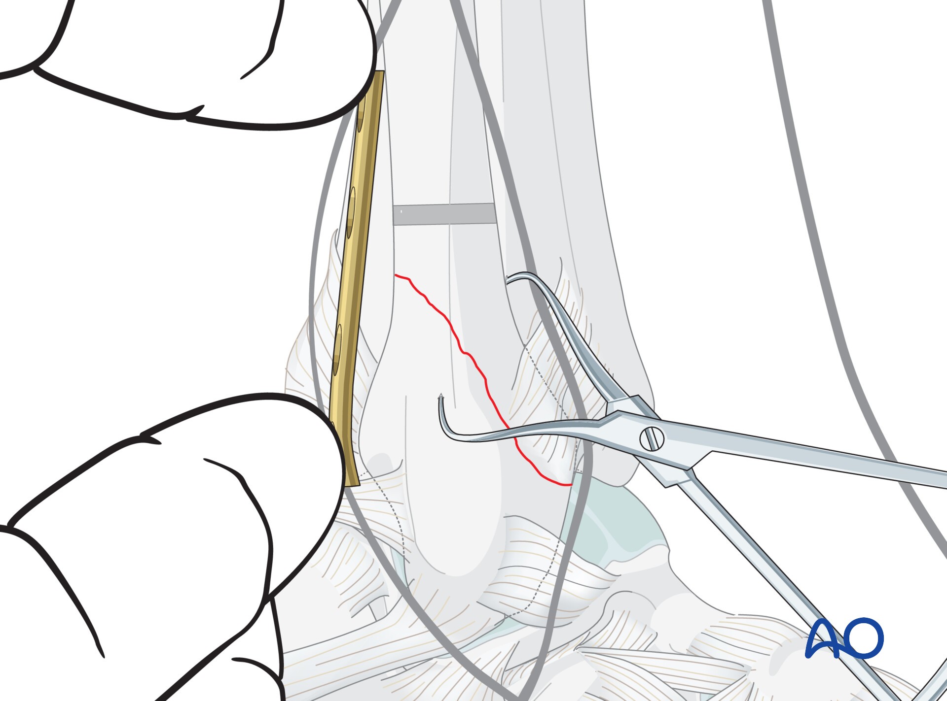 Antiglide plate for Transsyndesmotic lateral isolated simple fracture