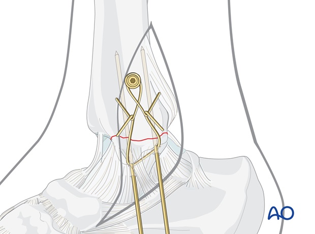 medial transverse fracture tension band wiring