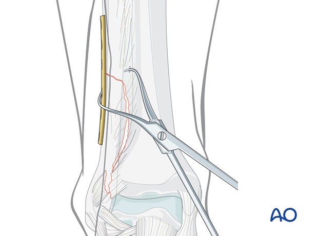 fibula transverse or oblique fracture compression plate