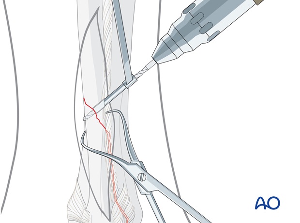 fibula oblique c1 fracture lag screw and neutralization plate
