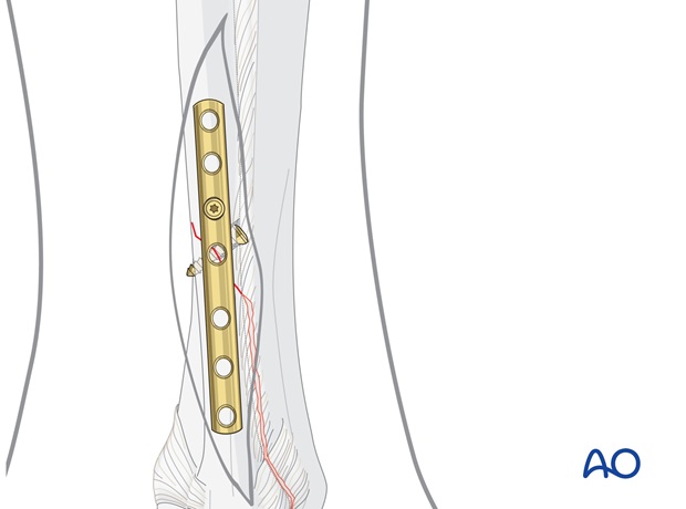 fibula oblique c1 fracture lag screw and neutralization plate