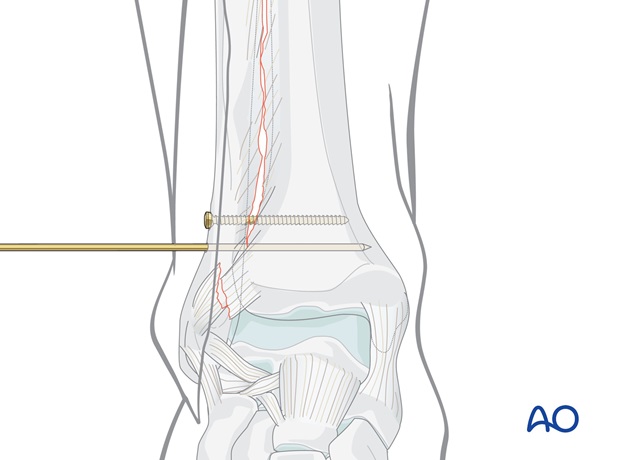 syndesmosis injury fibulo tibial positioning screw