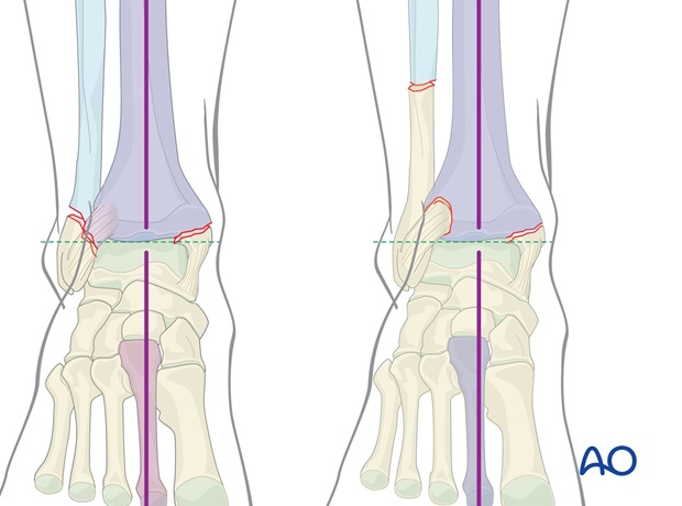 malleoli fracture management with minimal resources