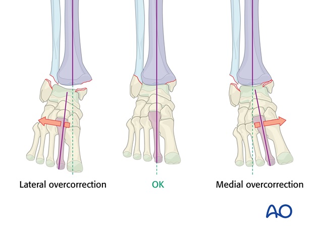malleoli fracture management with minimal resources