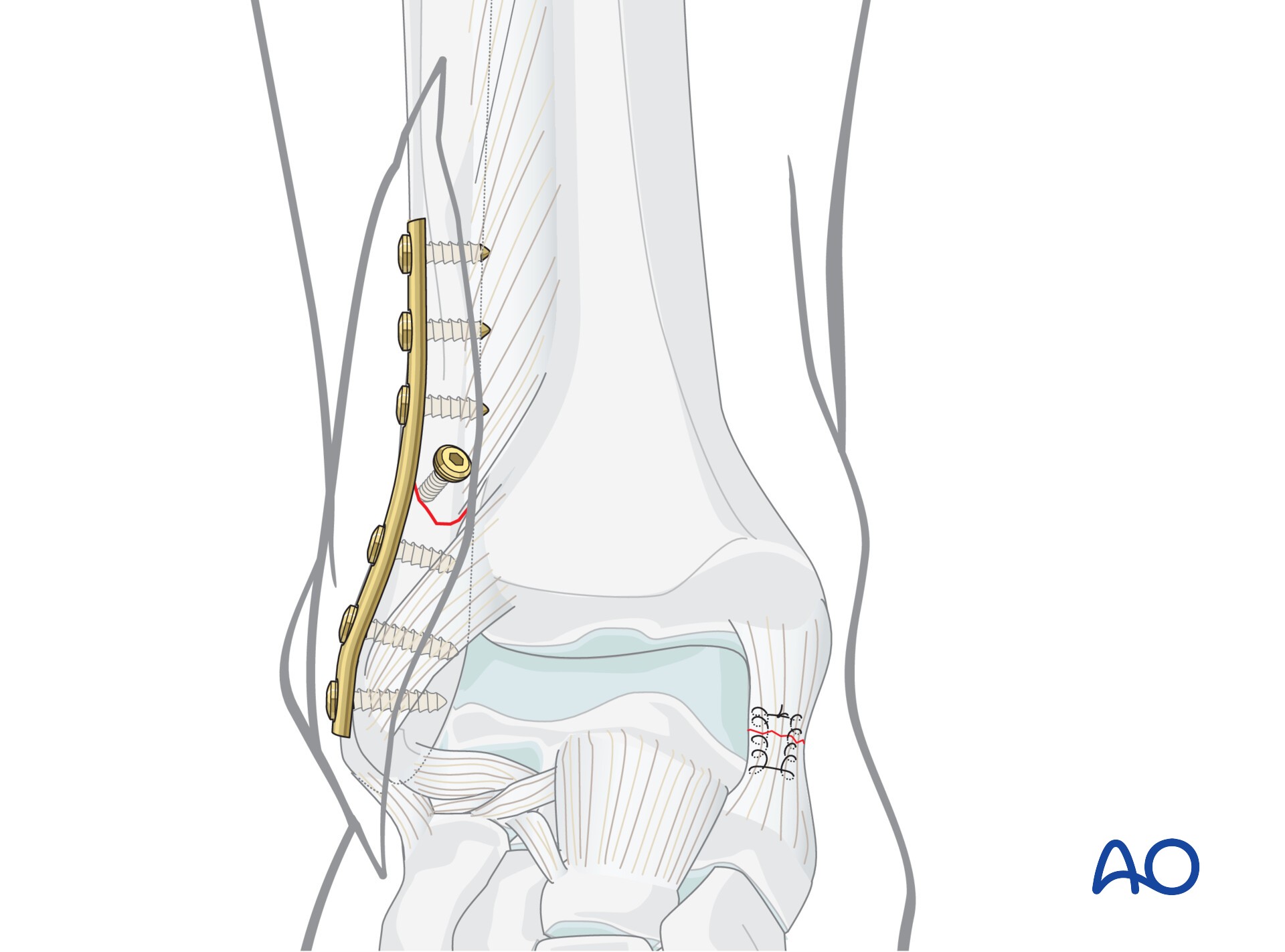 ORIF for Transsyndesmotic, lateral simple fracture with