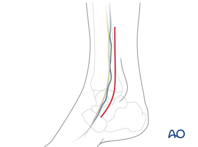 ORIF for Transsyndesmotic, posterior, lateral simple, and medial fractures