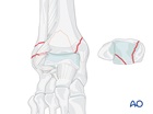 transsyndesmotic posterior lateral multifragmentary and medial fractures