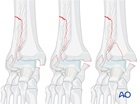 suprasyndesmotic simple fibular fracture medial injury posterior fracture