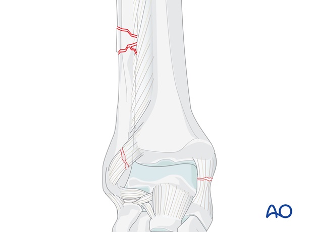 suprasyndesmotic multifragmentary fibula medial injury posterior fracture