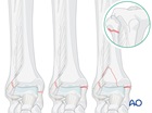 suprasyndesmotic proximal fibular fracture medial injury posterior fracture