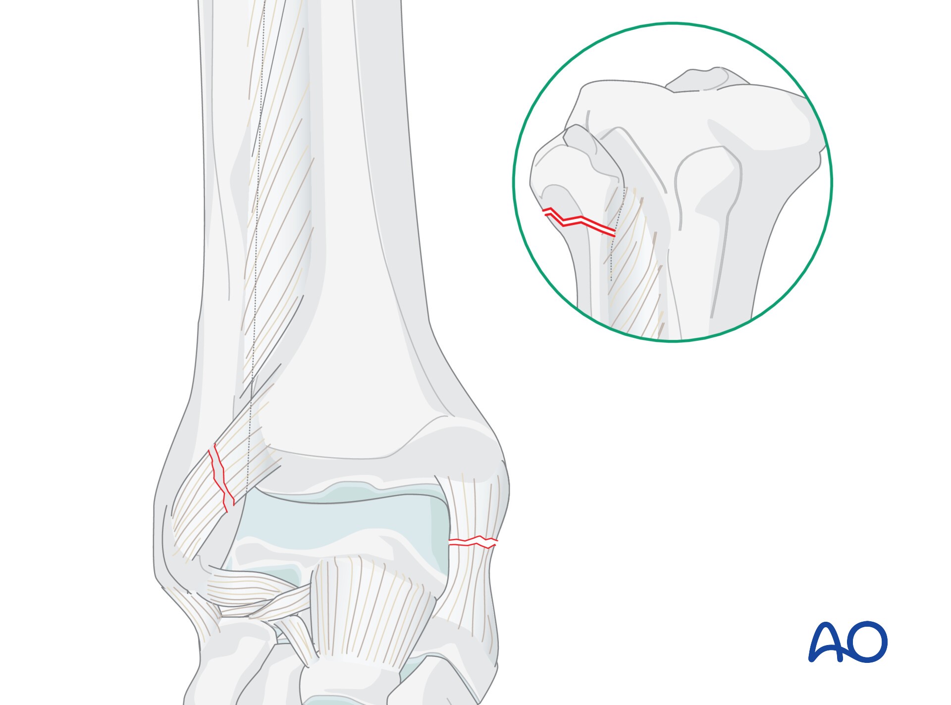 ＡＯ法骨折治療Ｆｏｏｔ　ａｎｄ　Ａｎｋｌｅ Amazon.co.jp: AO法骨折治療 Foot and Ankle [英語版Web付録付