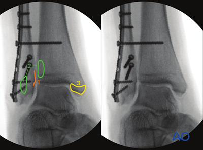 Intraoperative imaging of the ankle