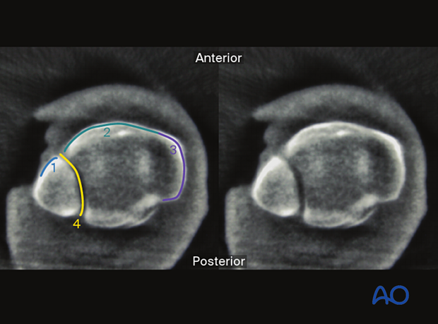 What can be seen in Axial plane (10 mm proximal to the talar joint line)