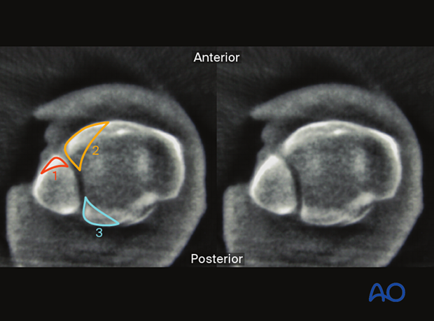 What can be observed in Axial plane (10 mm proximal to the talar joint line)
